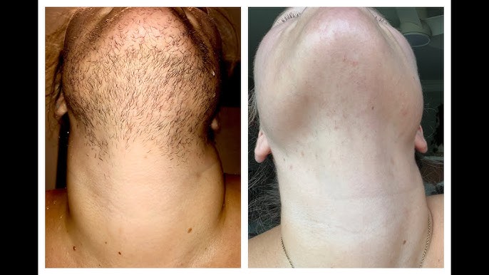 Gesichtsbehaarung Alltag